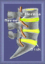Lateral view herniated disk