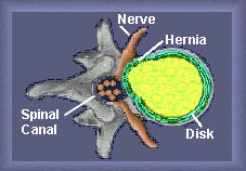 Top view herniated disk